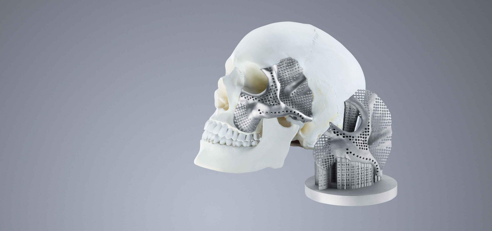 Global 3D-Printed Medical Implants Market to Experience Significant